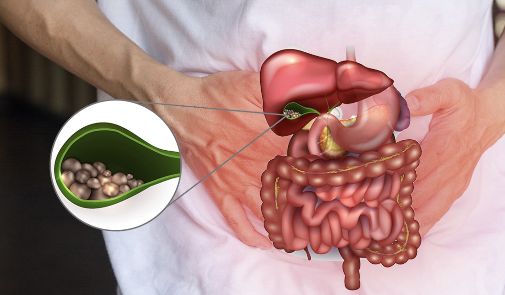 gallstones.png