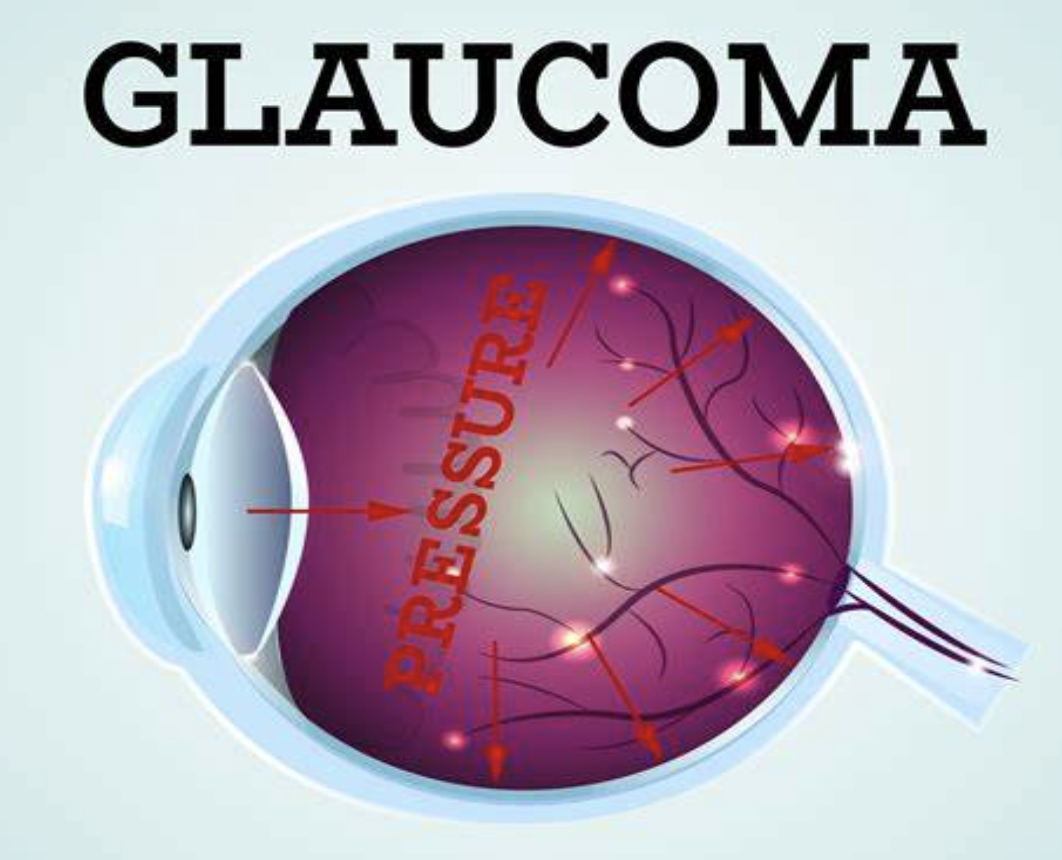 glaucoma.png