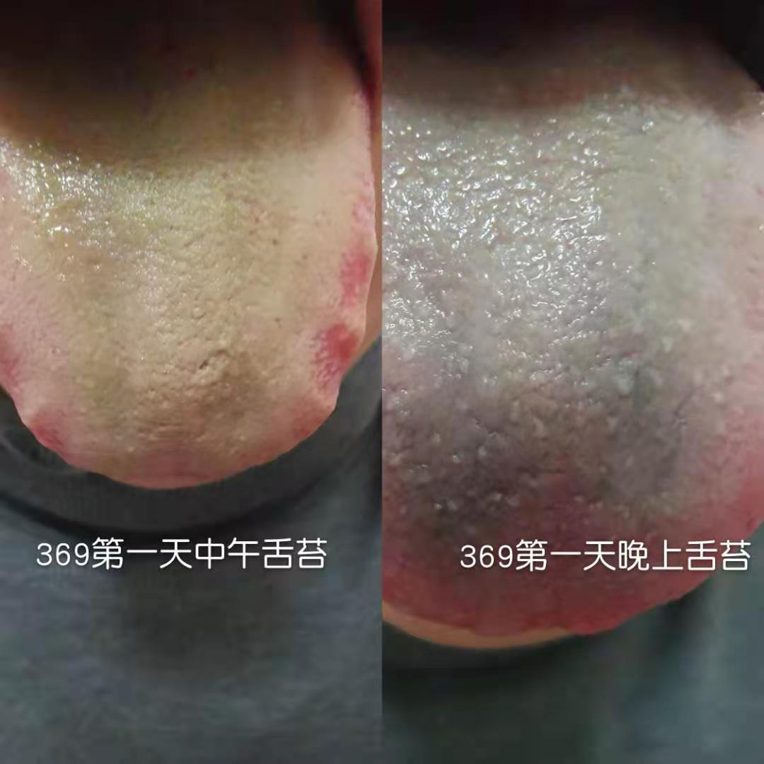 排毒反应 黑舌苔 口腔有金属味道 排便有金属物质 气味 氧化重金属排出 安疗网