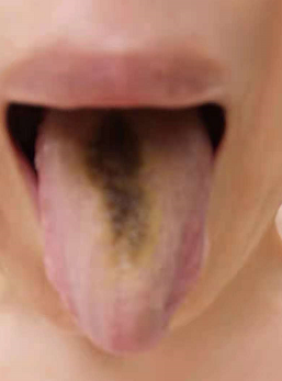 排毒反应：黑舌苔，口腔有金属味道，排便有金属物质/气味（氧化重金属排出）