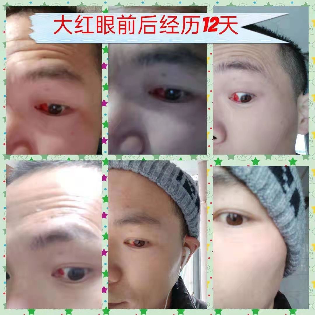 红眼病，红色眼睛，眼睛血丝视频素材,生物医疗视频素材下载,高清1920X1080视频素材下载,凌晨两点视频素材网,编号:218169