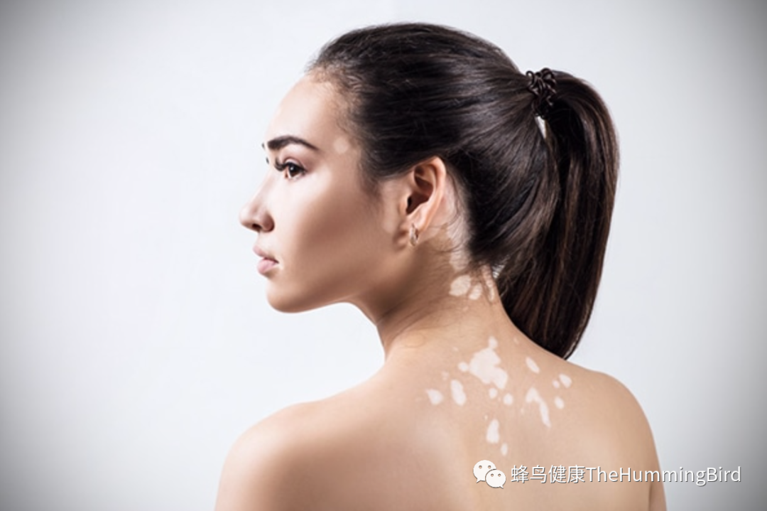 白癜风的原因和疗愈 Healing Vitiligo-图片1