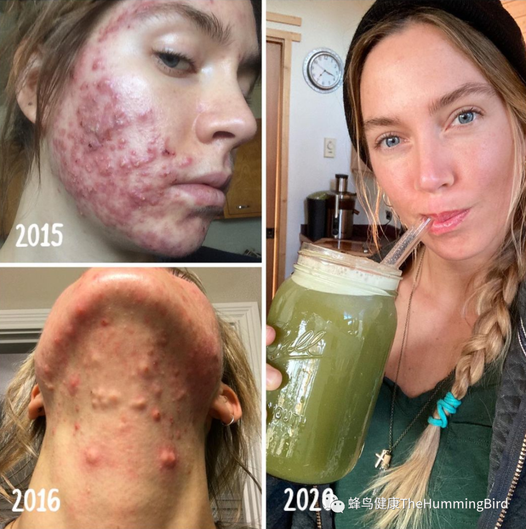 疗愈故事（42）- 青春痘的疗愈 Healing Story(42) – Acne &Skin Conditions