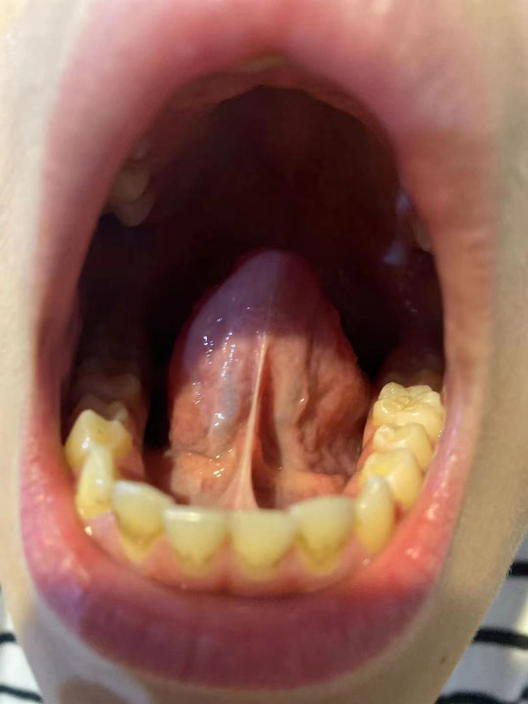 舌下青筋血管（淤血）颜色变浅