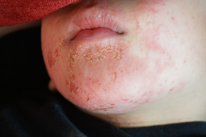 孩子多年异位性皮肤炎的疗愈案例