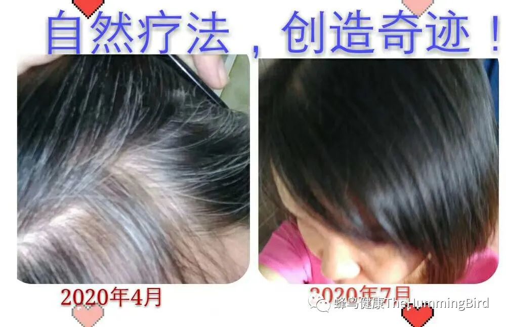 【实践分享】头发和发质（脱发、掉发、斑秃、白发转黑、发量增加、发际线）、头皮屑、头皮痒