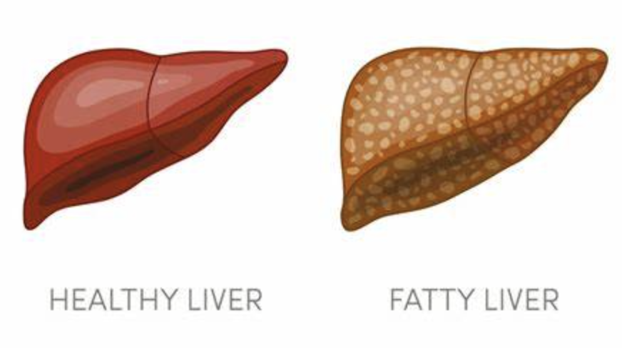 【补充剂方】- 脂肪肝、预脂肪肝和肝脏停滞迟缓