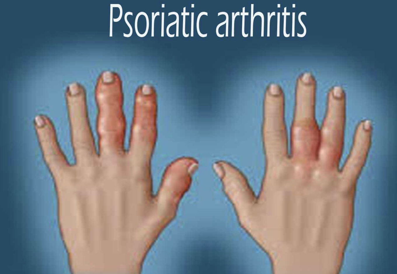 psoriatic arthritis.png