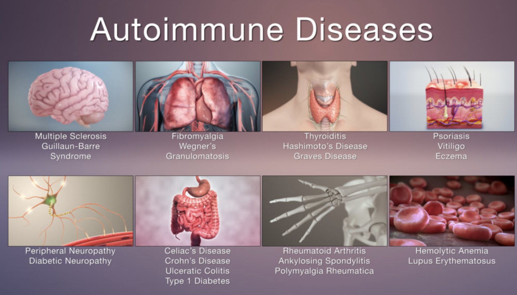 Guillain-Barré Syndrome / Recovery from Guillain Barre Syndrome ...