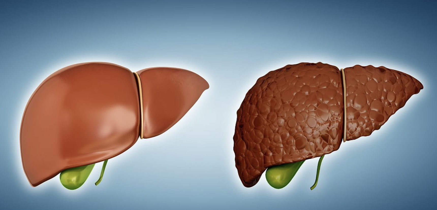 liver cirrrosis.png
