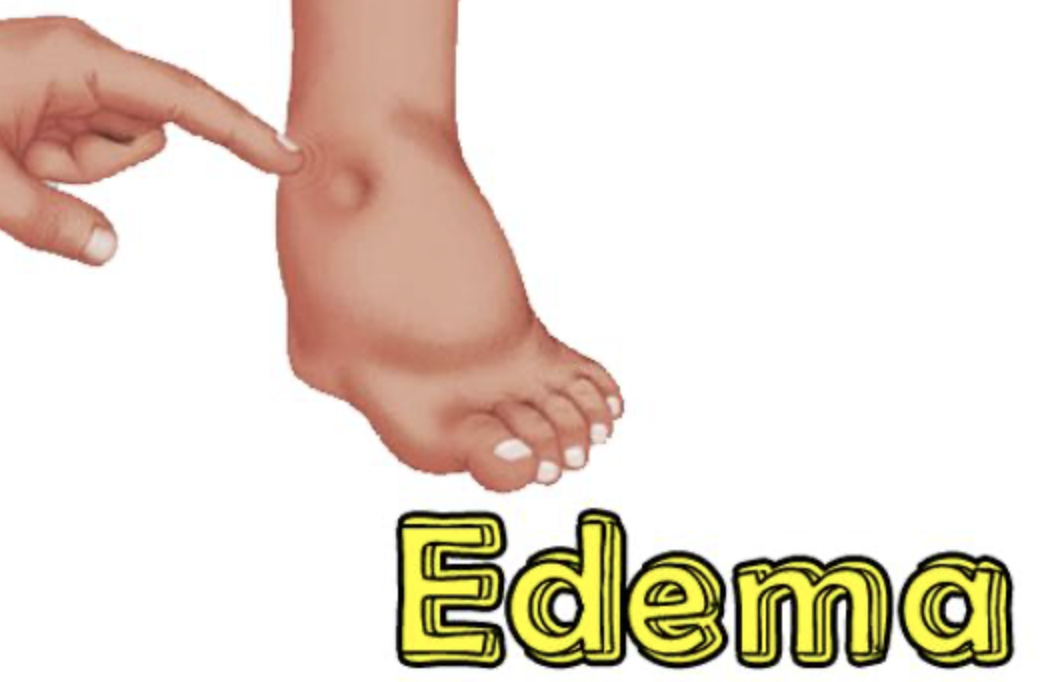 edema.png