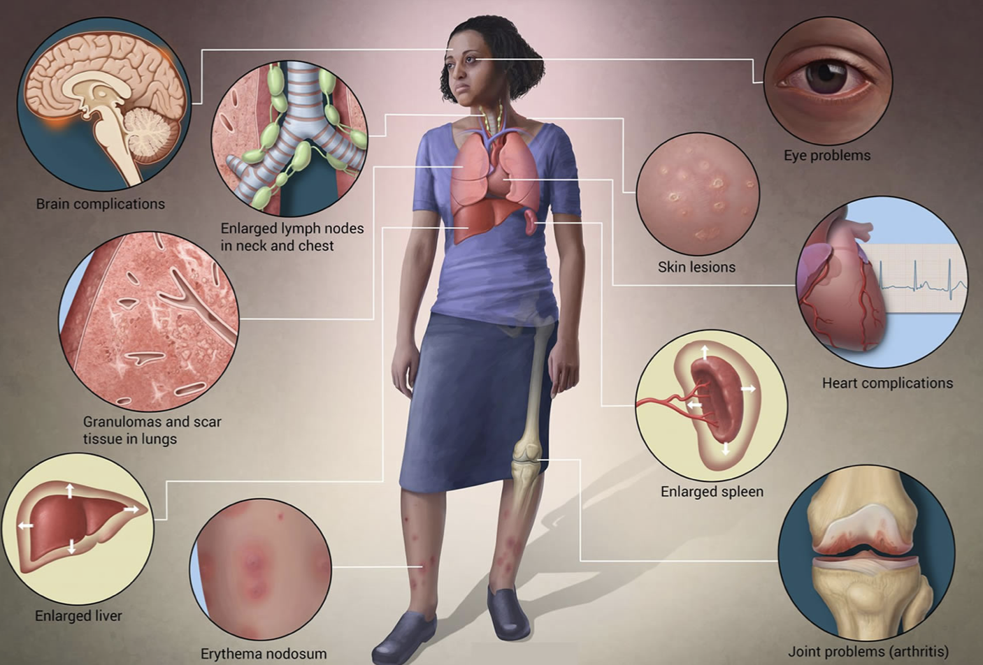 sarcoidosis.png