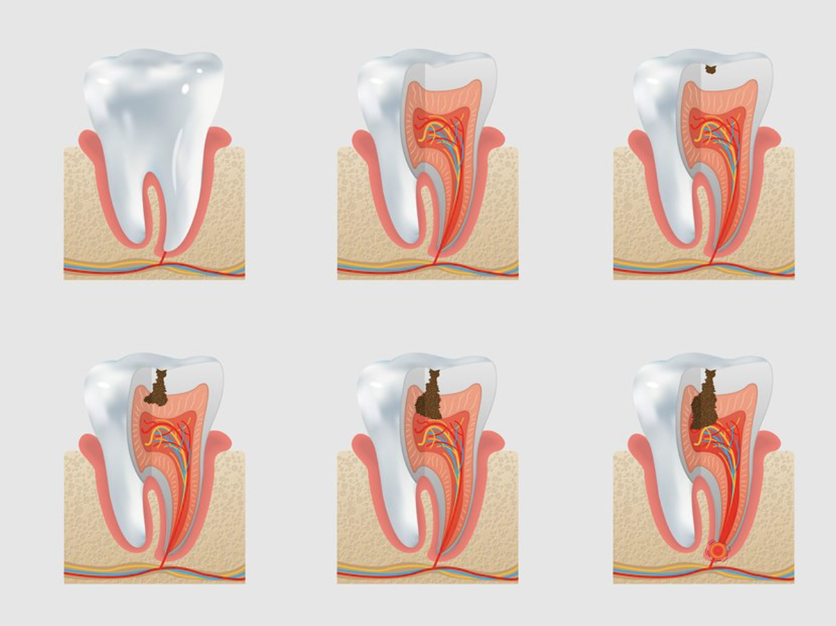 dental cavity.png