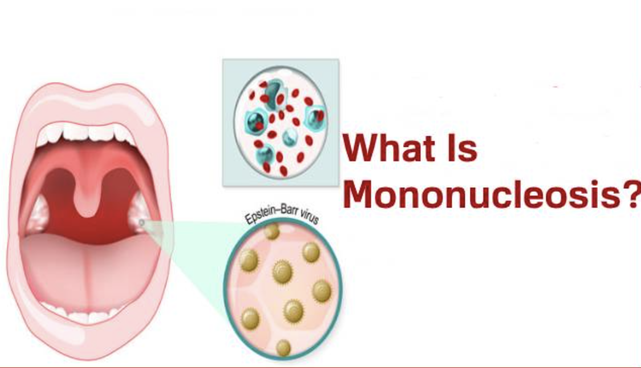 mononucleosis.png