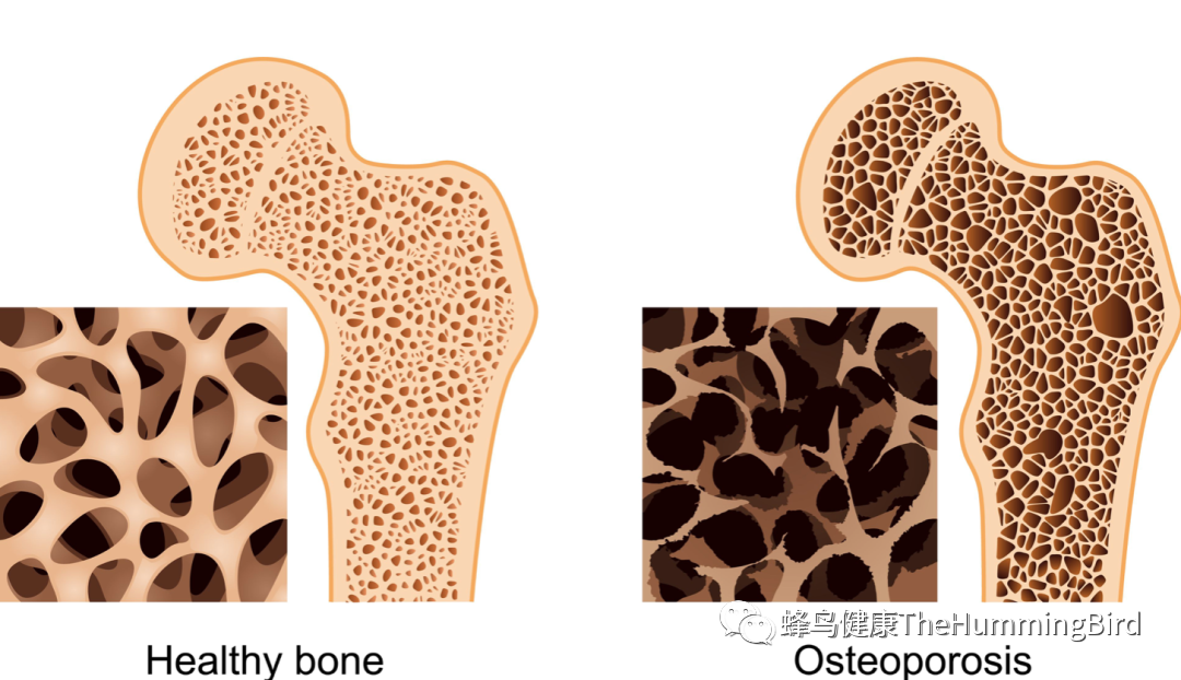 骨质疏松和骨质减少