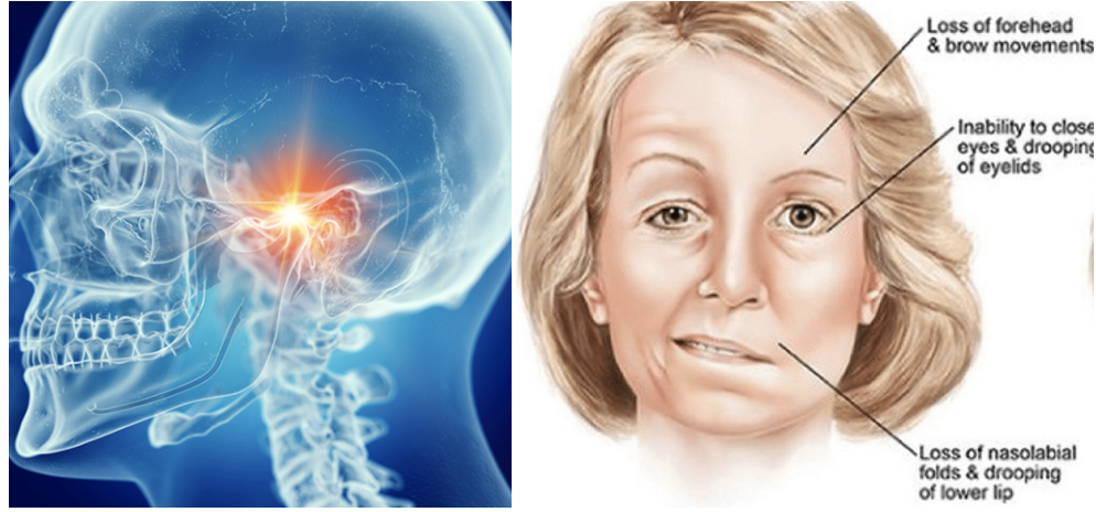 TMJ bell palsy.png