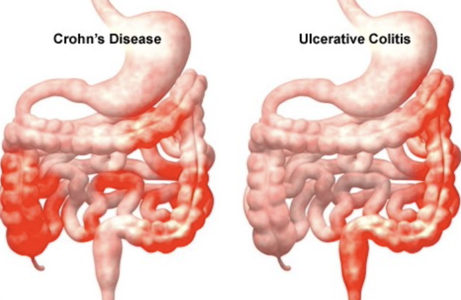 colitis chrohns.png