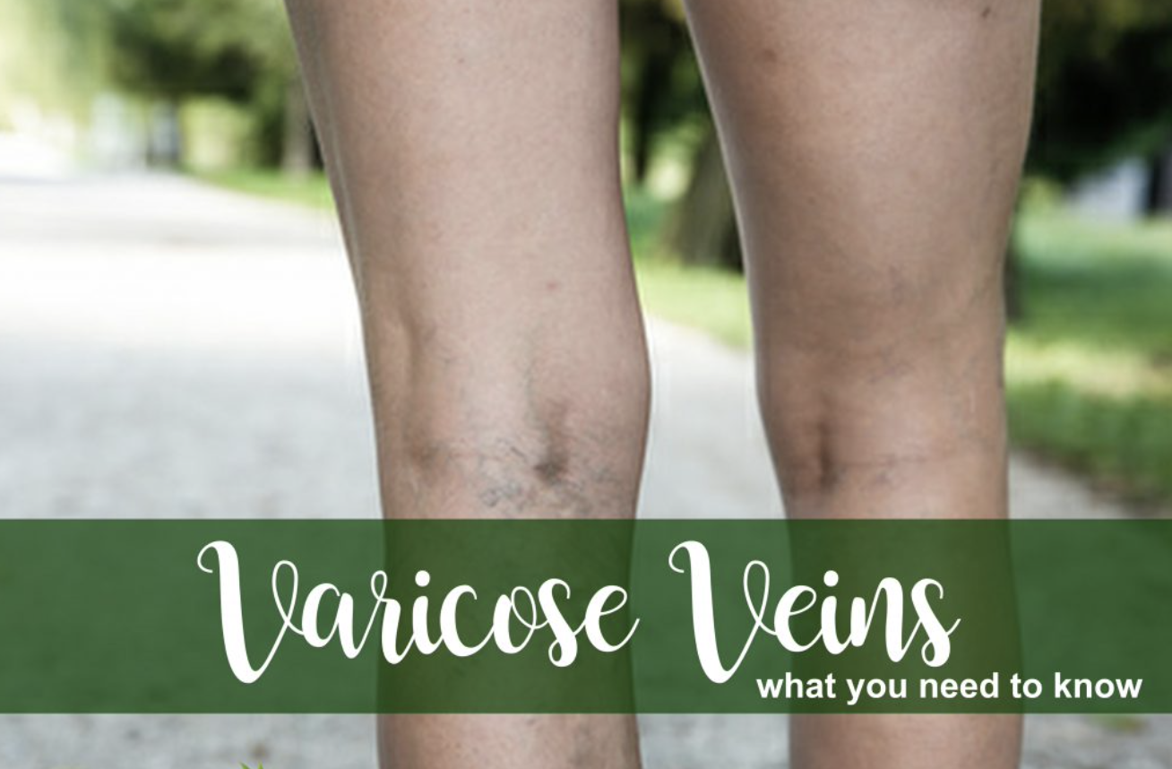 varicose veins 1.png