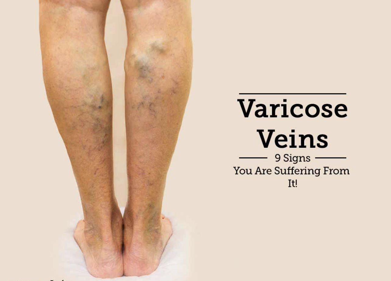 varicose veins 2.png