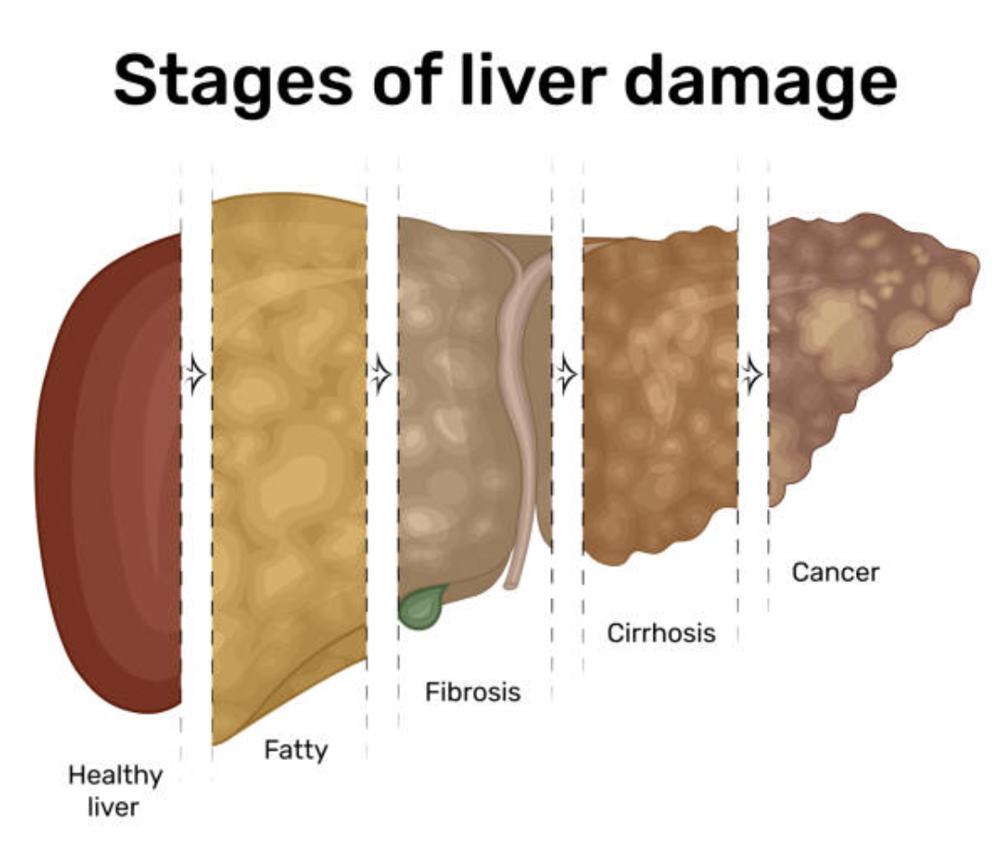 stages of liver problem.png