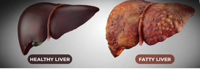 fatty liver 3.png