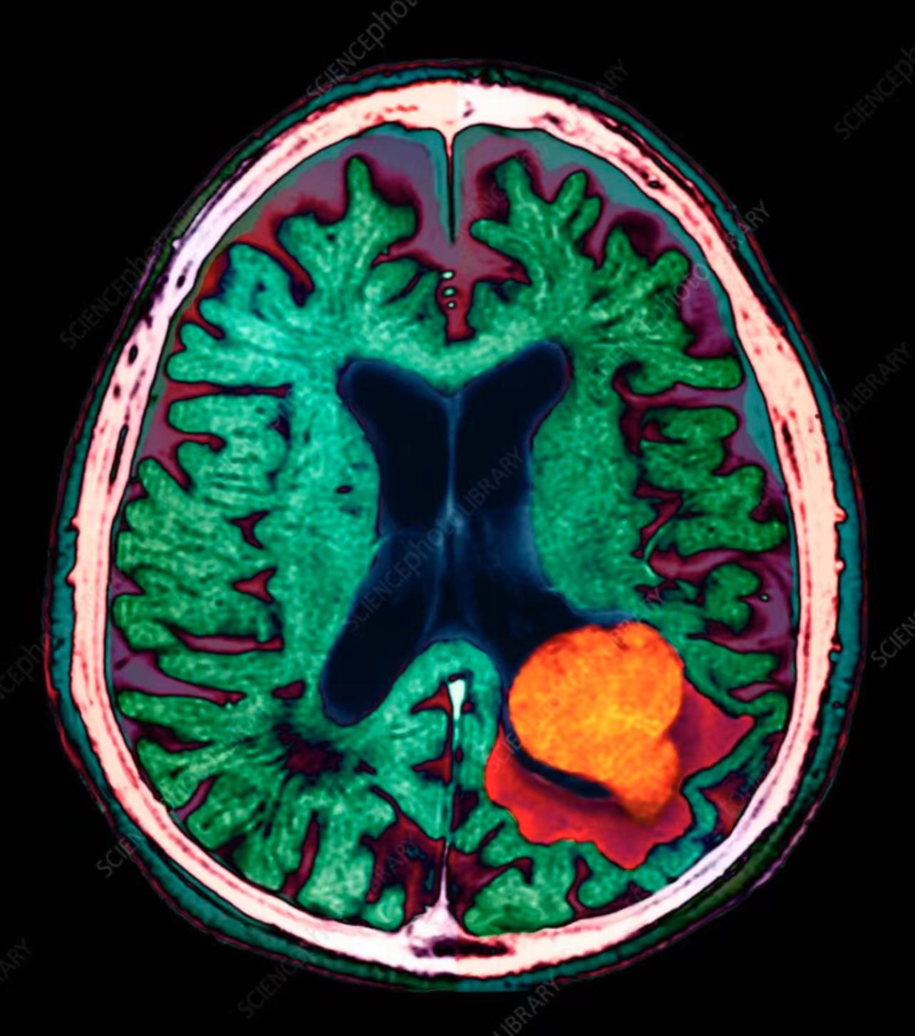 【补充剂方】-大脑病变、脑钙化、大脑黑斑、脑部疤痕组织、脑部白斑