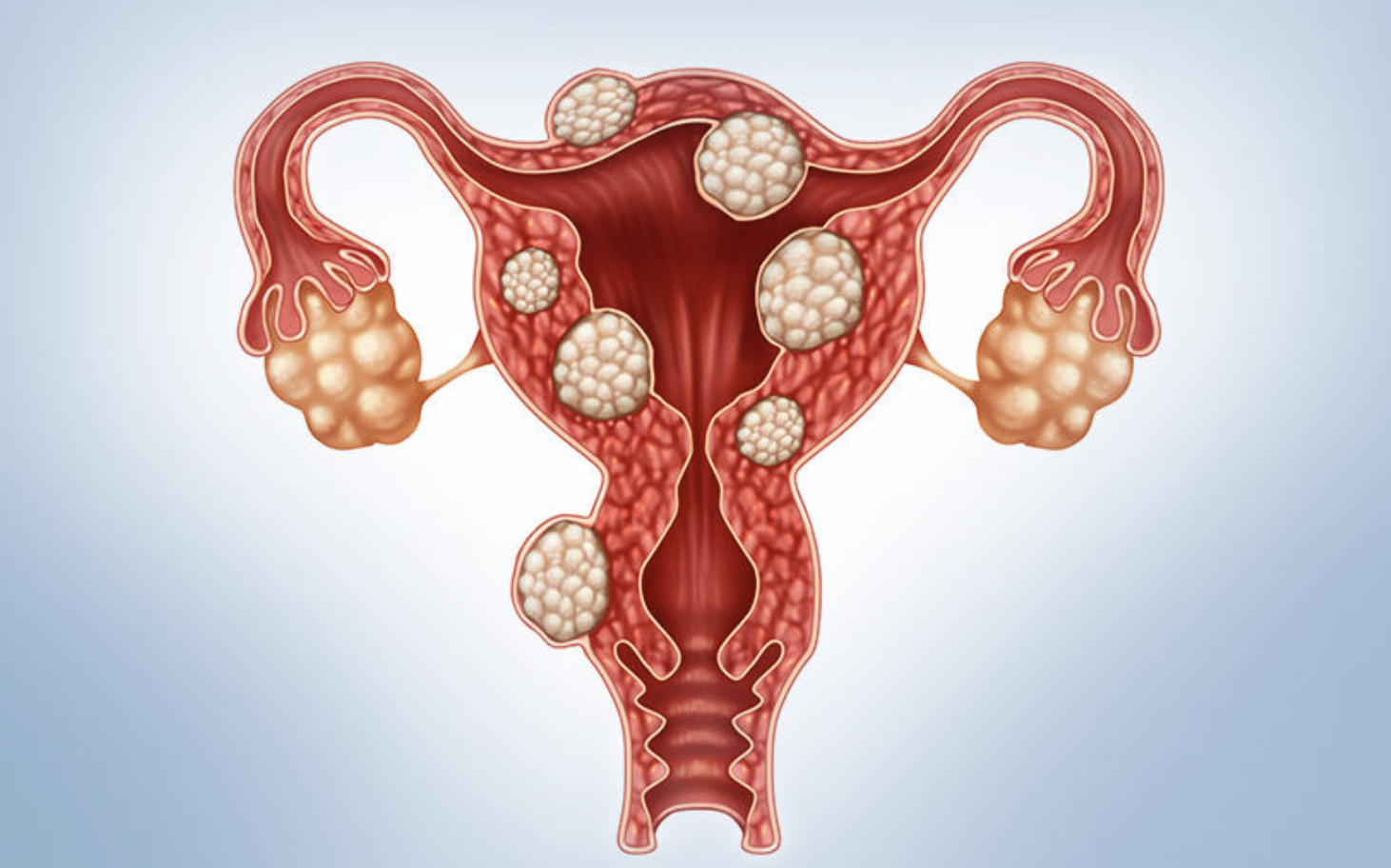 fibroids.png