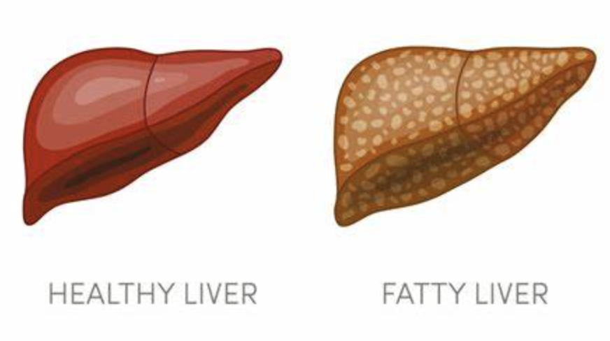 fatty liver.png