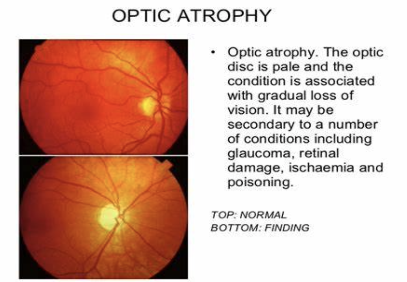 optic nerve atrophy.png