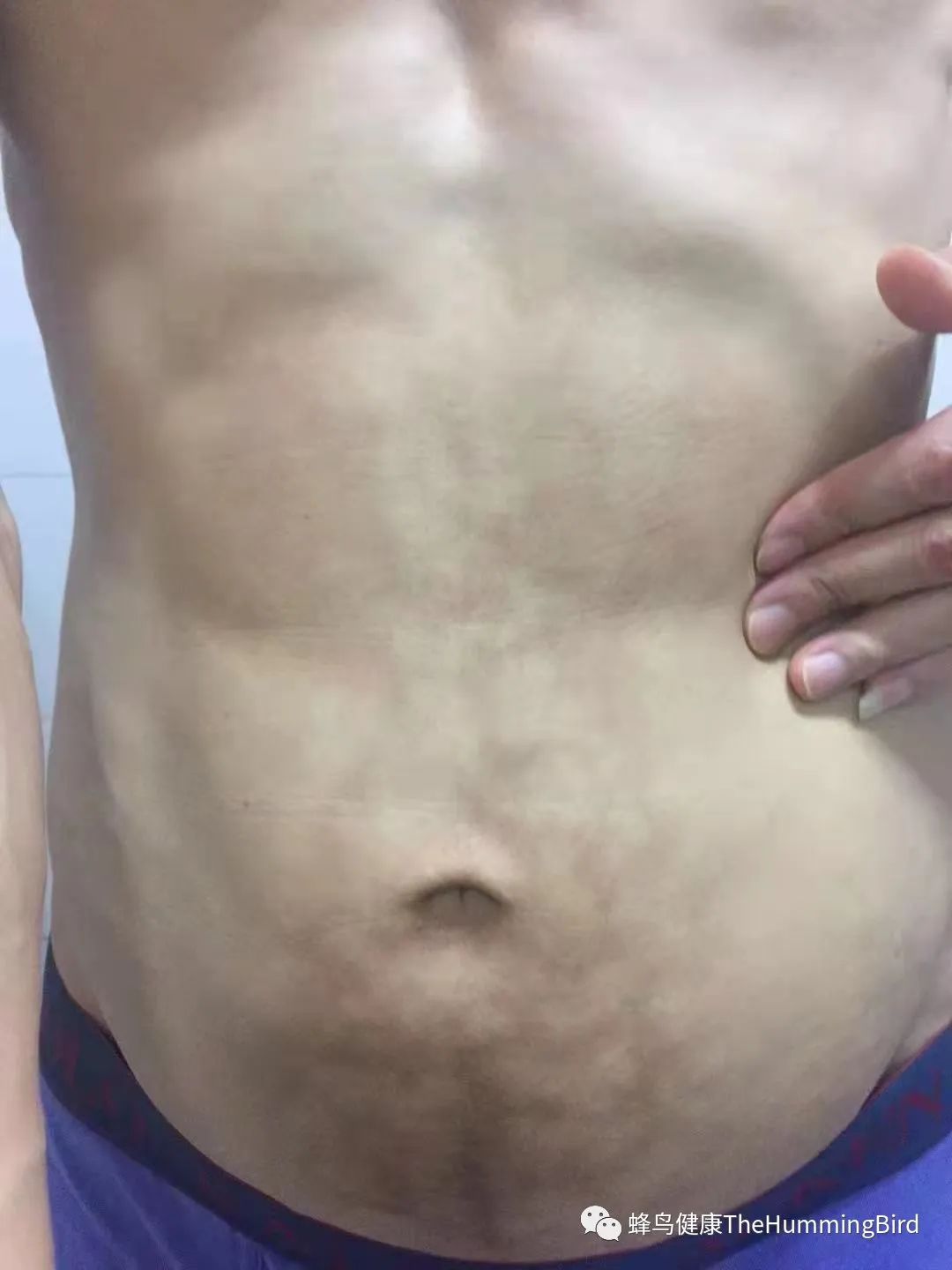 中国疗愈故事(9)- 告别死亡判决书(肝衰竭、肝硬化、重症肝炎)-图片17