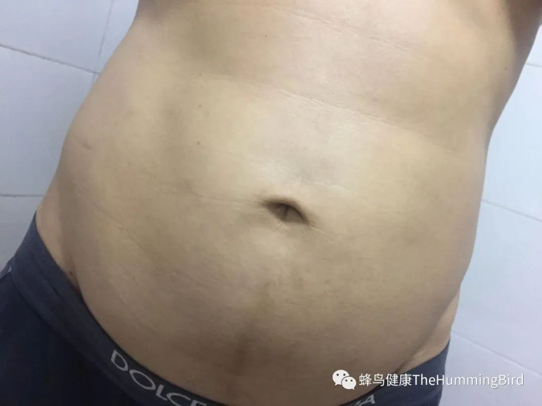 中国疗愈故事(9)- 告别死亡判决书(肝衰竭、肝硬化、重症肝炎)-图片6