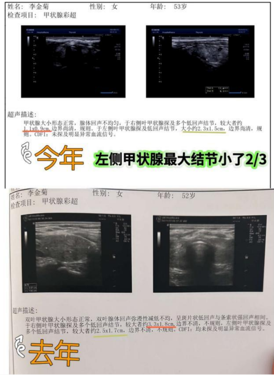 【中国疗愈案例】 湿疹、三高、严重嗜睡、颈动脉斑块、肺结节、子宫肌瘤-图片4