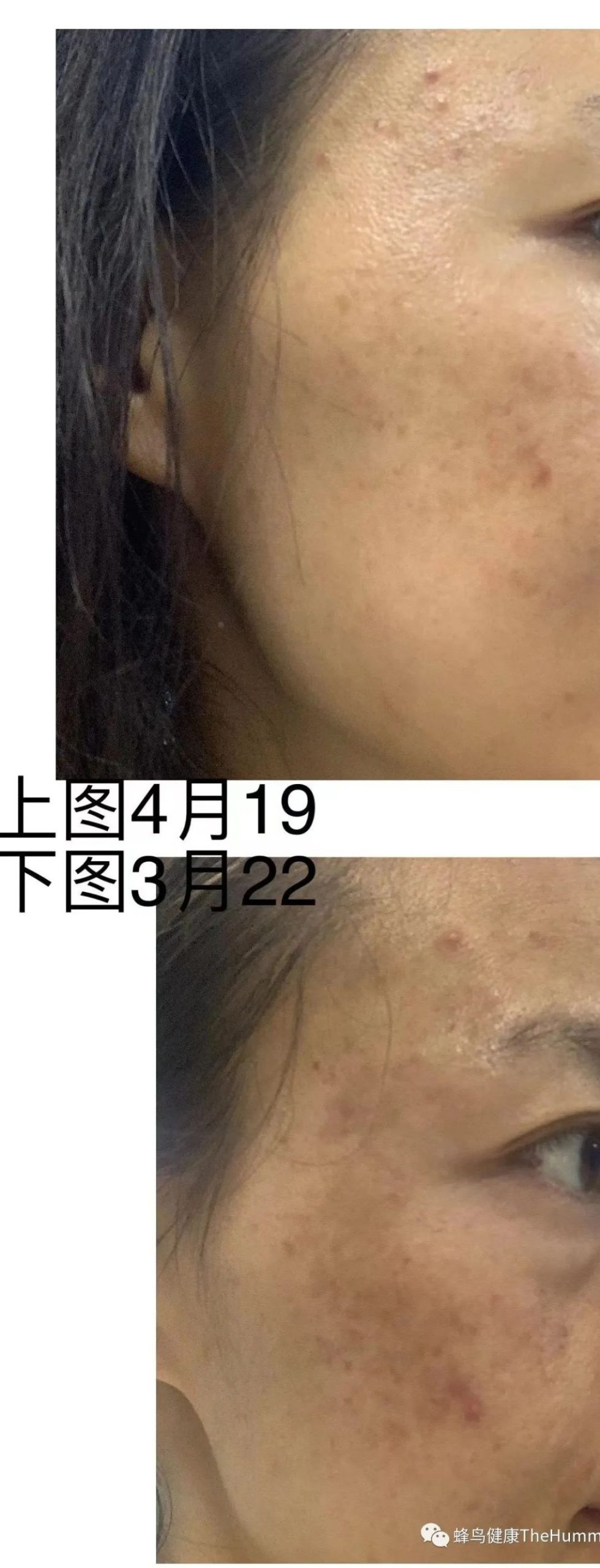 【疗愈案例】 色斑（黄褐斑）、酒糟鼻-图片2