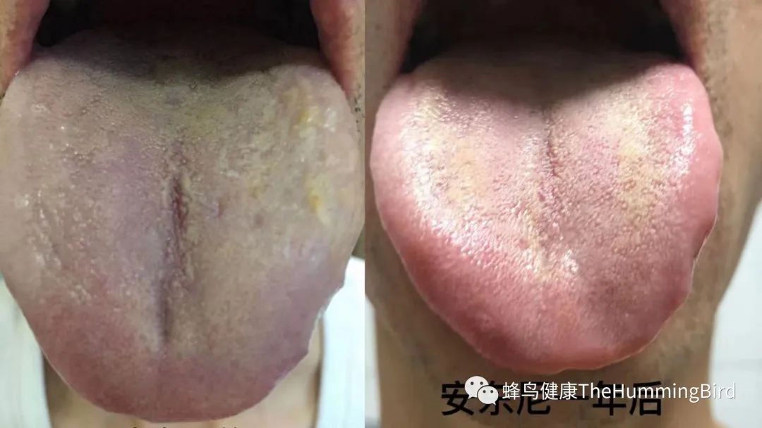 中国疗愈故事(9)- 告别死亡判决书(肝衰竭、肝硬化、重症肝炎)-图片12