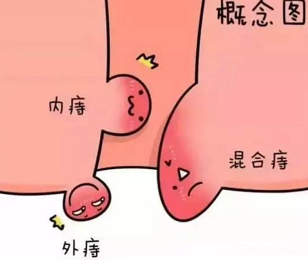 痔疮