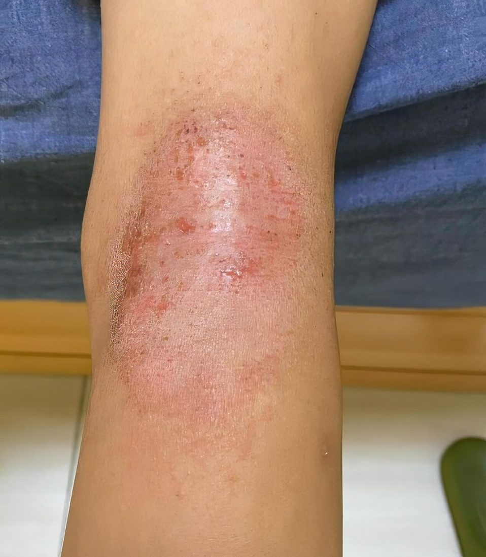 【疗愈案例】 异位性皮炎、过敏、怕冷、腰酸背痛、皮肤和体力改善等