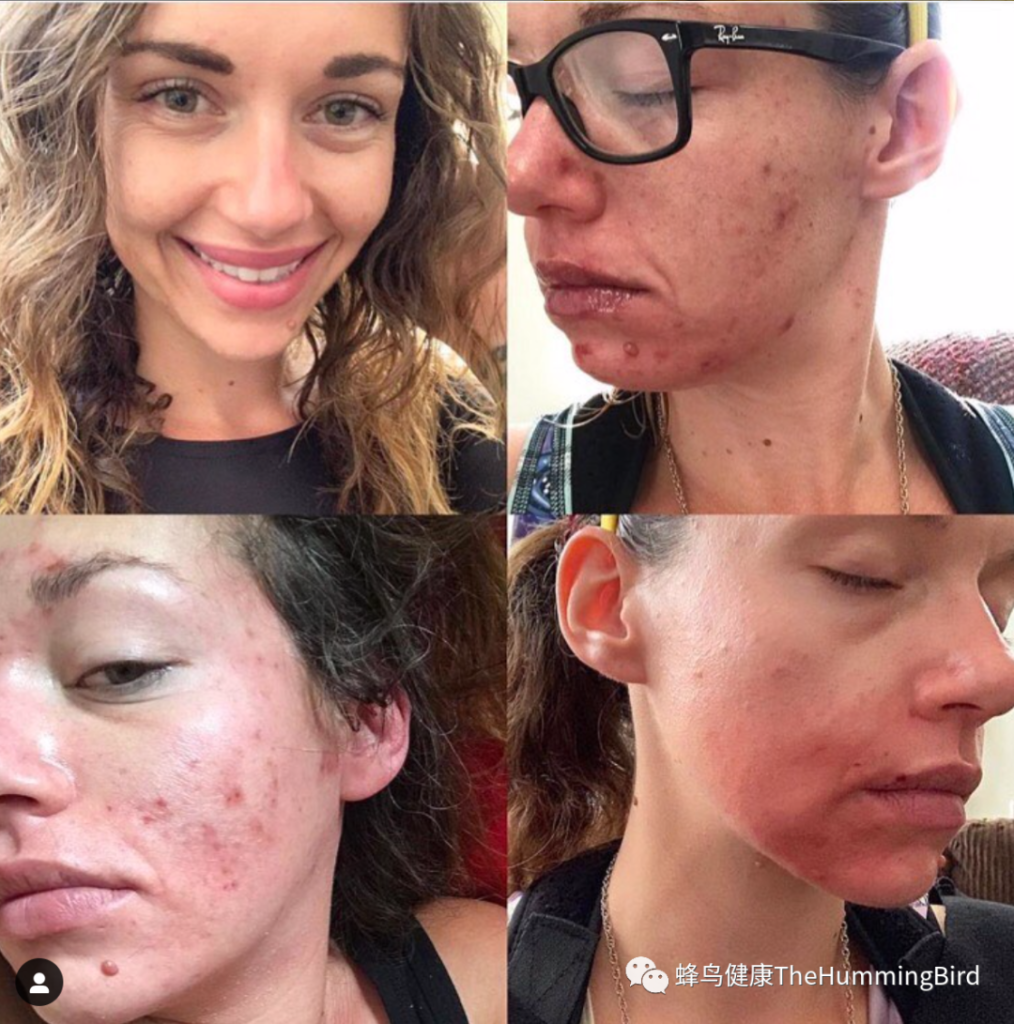 【疗愈案例】几十种症状的疗愈（激素失衡、经期问题、腹胀、肿胀、抑郁焦虑和情绪波动、发麻）