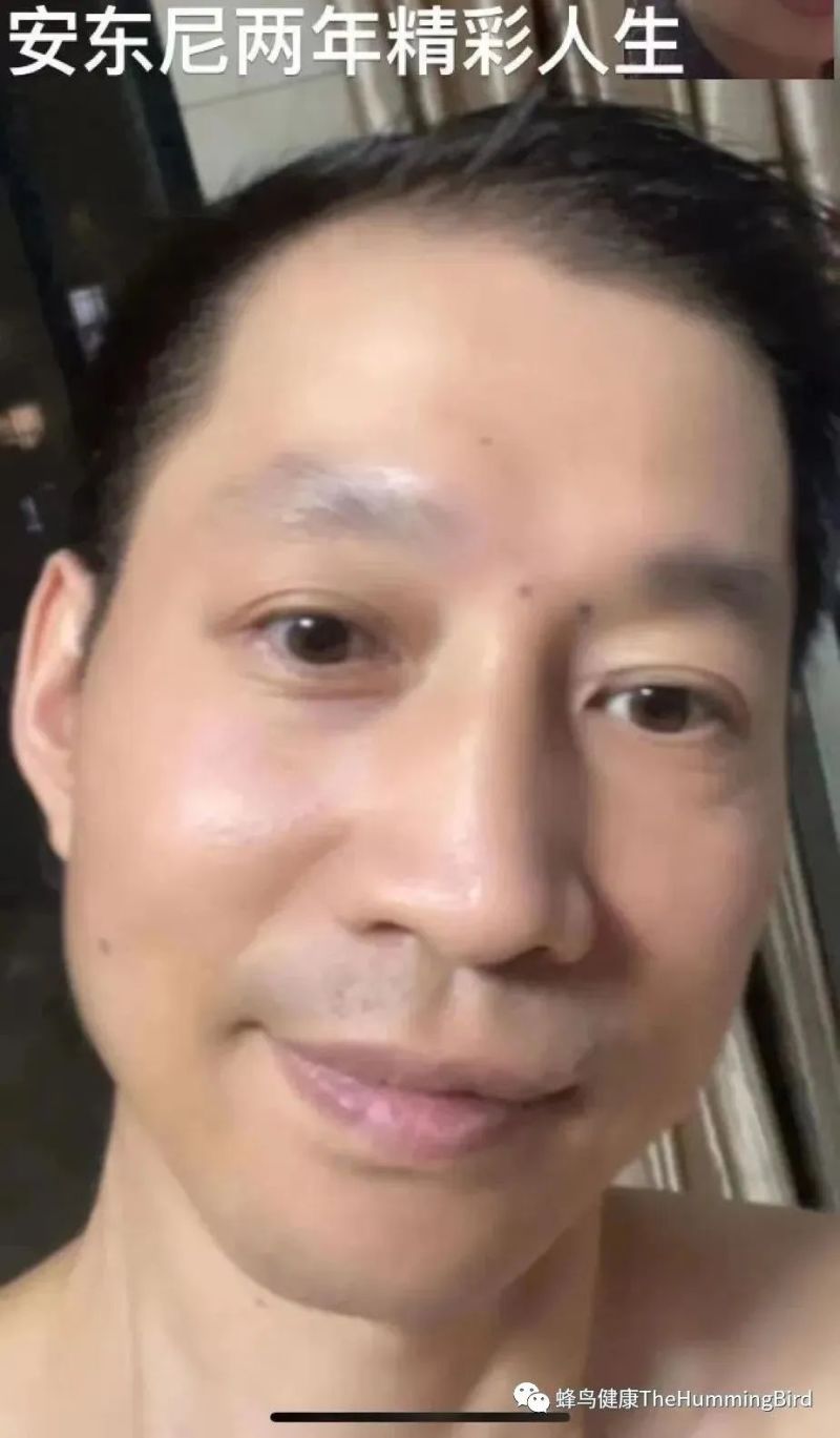 中国疗愈故事(9)- 告别死亡判决书(肝衰竭、肝硬化、重症肝炎)-图片1