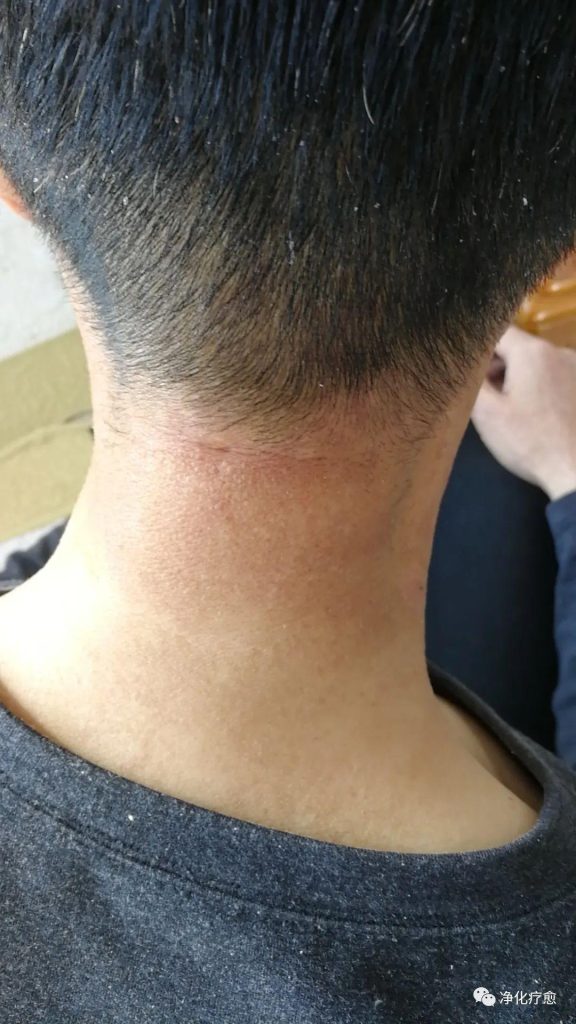 【疗愈案例】紫外线过敏、皮肤干裂、逆转脾胃“寒凉”、便秘问题-图片2