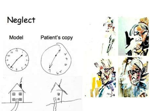 【补充剂方】-半侧空间忽视、左侧忽视、右空间忽视