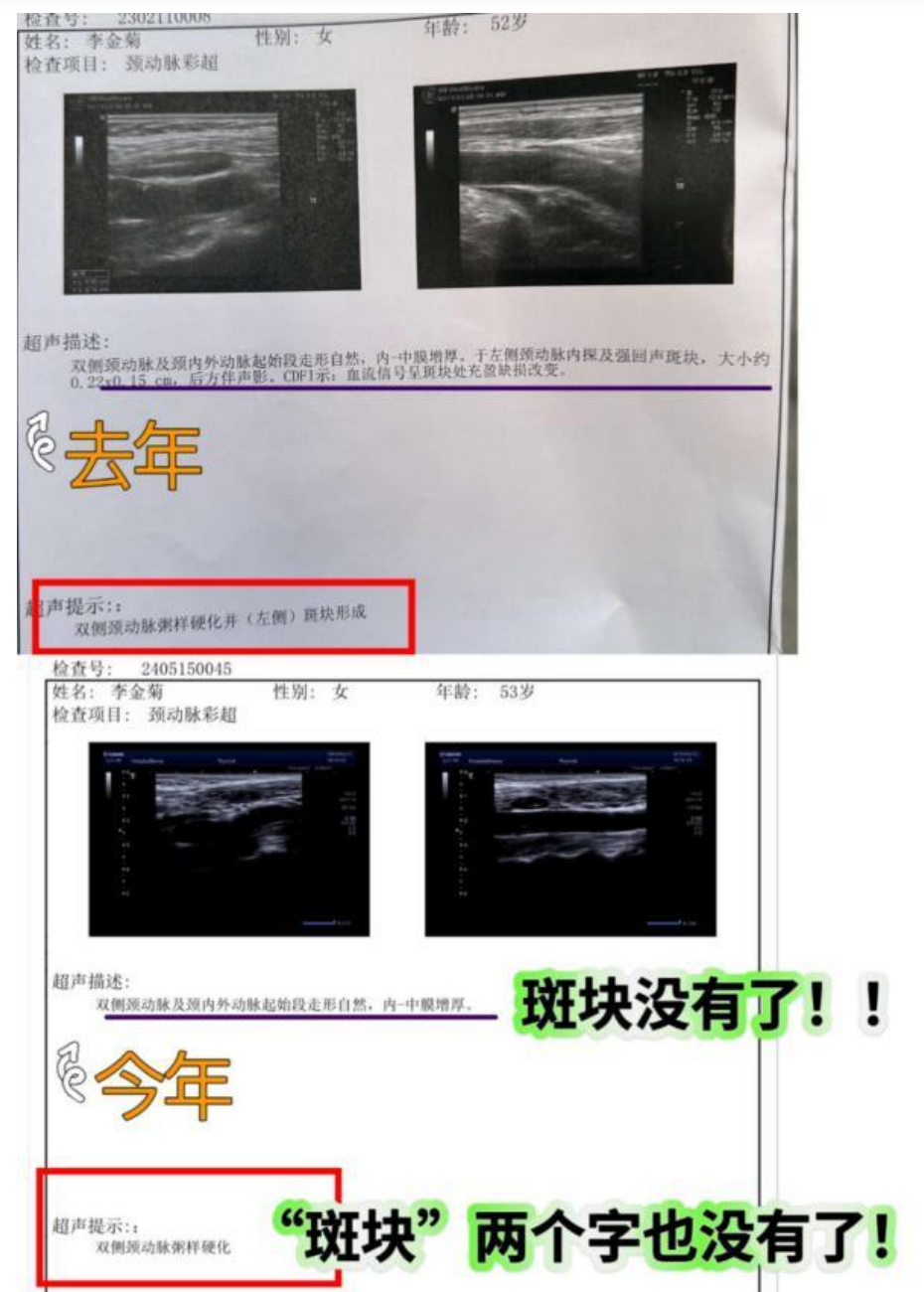 【中国疗愈案例】 湿疹、三高、严重嗜睡、颈动脉斑块、肺结节、子宫肌瘤-图片3