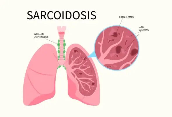 【摘要速查】 自体免疫疾病（桥本甲状腺炎、狼疮、多发性硬化症、莱姆病、类风湿关节炎、银屑病牛皮癣关节炎、艾迪生病、格林巴利综合症-图片9