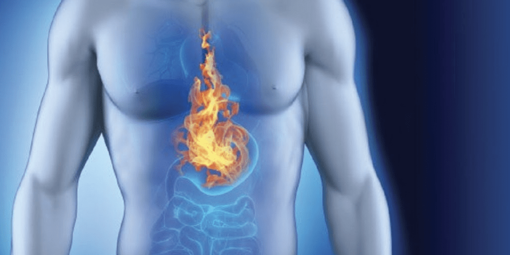 酸反流（酸返流）-图片1